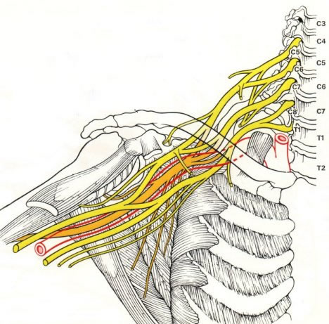 Przebieg nerwów splotu barkowego wraz z miejscem częstego ucisku na nerwy - przestrzeń między obojczykiem, a pierwszym żebrem